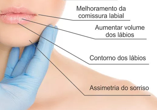 thumb-botox-e-preenchimento05