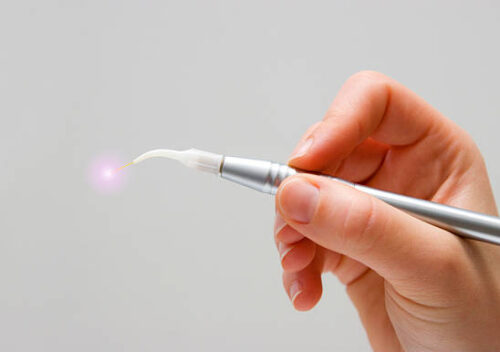 A dentists hand holds a activated dental laser system in his hand. Grey background