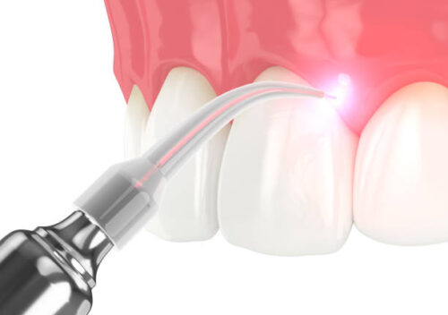 3d render of dental diode laser used to treat gums. The concept of using laser therapy in the treatment of gums